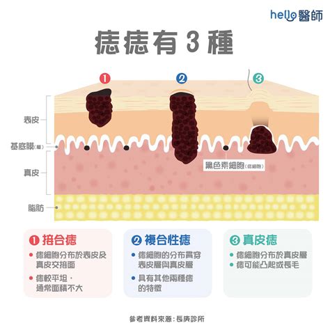 手掌突然長痣|痣形成的原因？痣長毛、痣變多變大是痣病變？5招判別